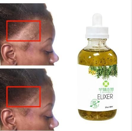 Scalp Elixirs Hair Care Loss Treatment Hair Growth Oil Serum (60 ML).