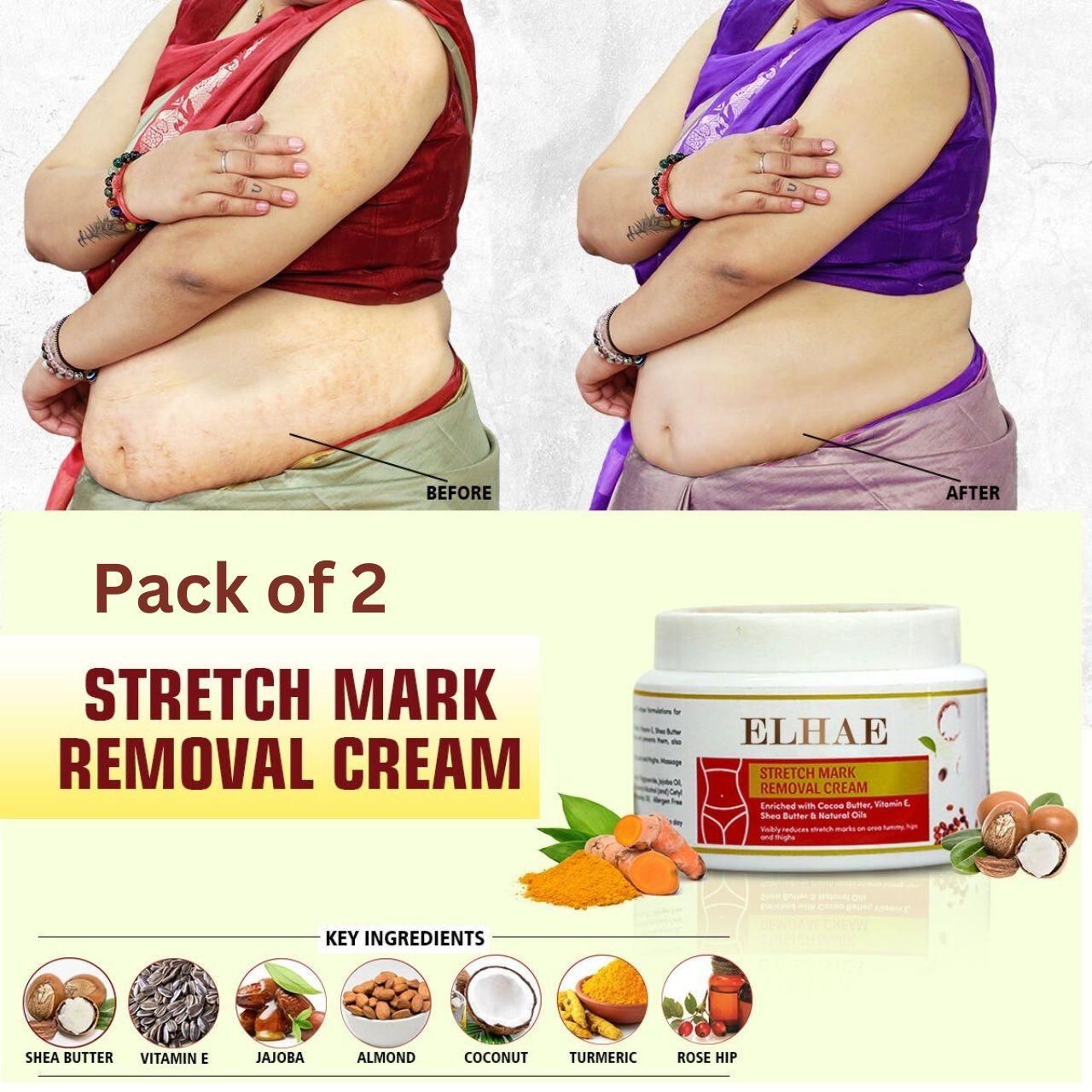 Stretch Mark Removal Cream (Pack of 2)