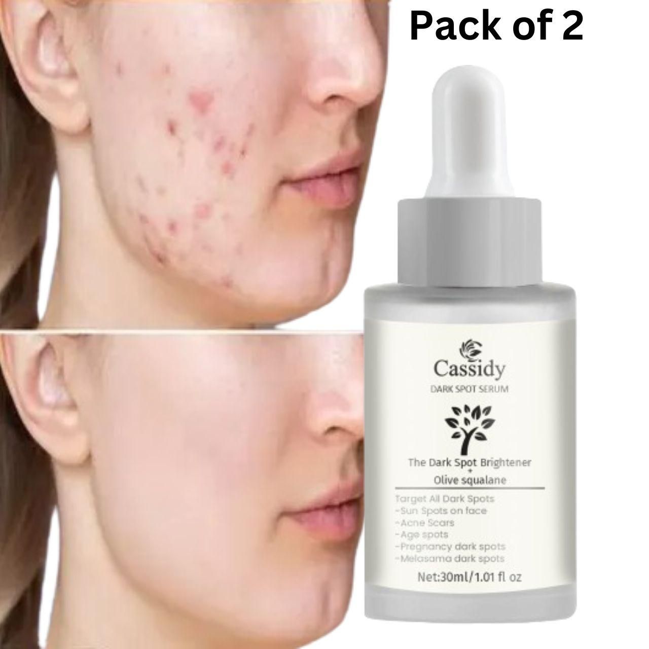 CASSIDY Dark Spot Serum Dark Spot Brightener and Olive Squalane Remove Acne Scars (Pack of 2)