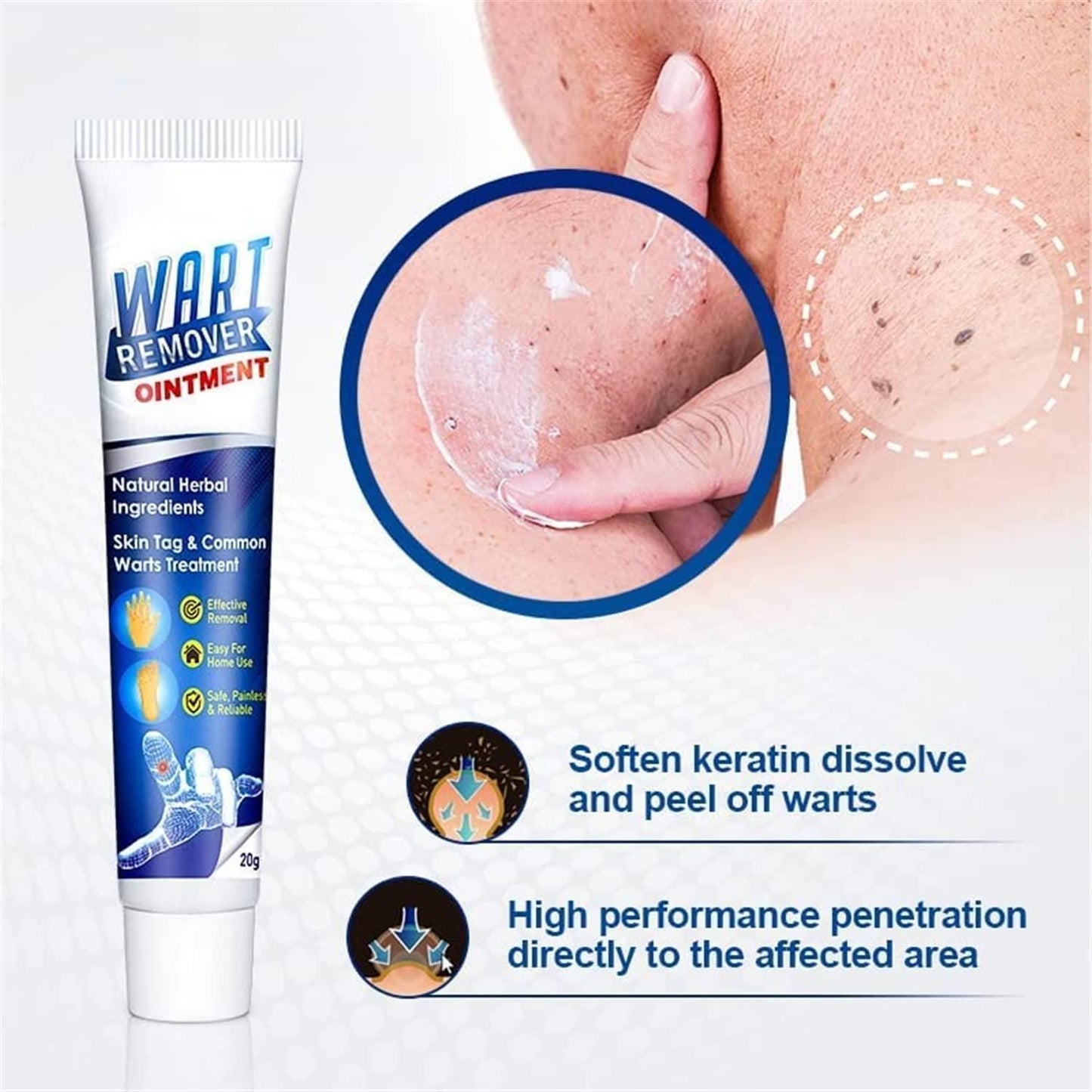 Warts Removal Cream 100 g (Pack of 2)